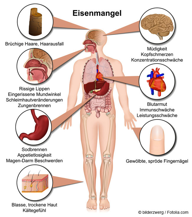 Übersicht Eisenmangel beim Menschen © bilderzwerg /fotolia.com